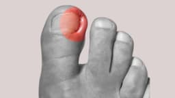 Cách xử lý móng chân mọc ngược an toàn theo từng mức độ