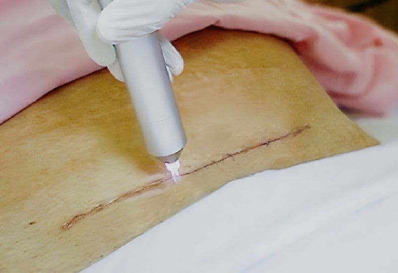 chiếu tia plasma vào vết khâu tầng sinh môn