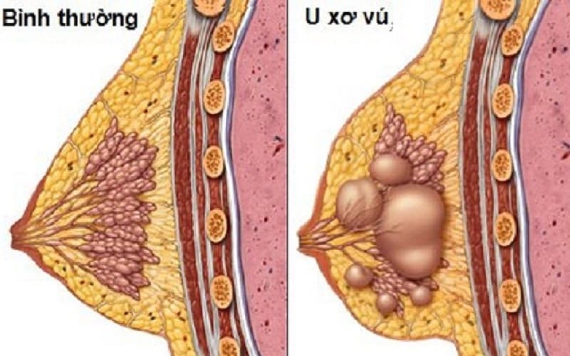 bầu có siêu âm vú được không