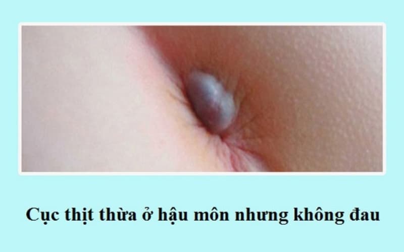 nếp da thừa hậu môn ở trẻ