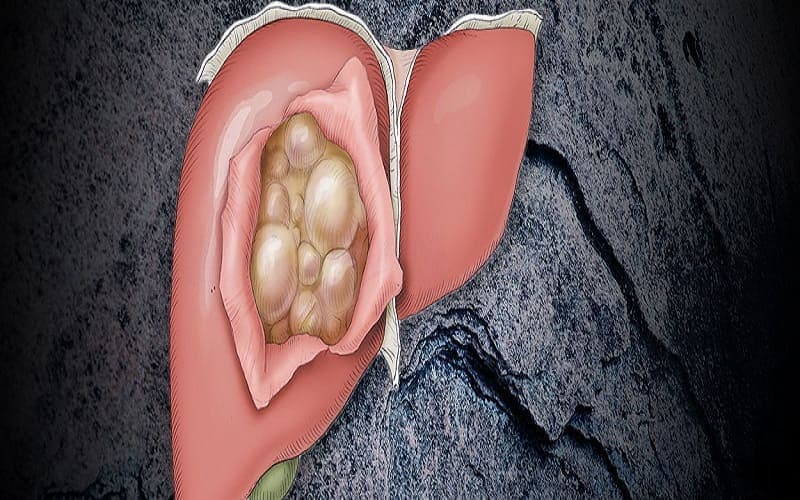 dấu hiệu u gan lành tính