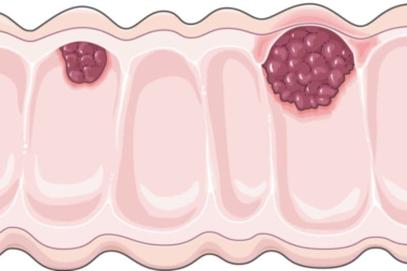 các giai đoạn của ung thư đại trực tràng