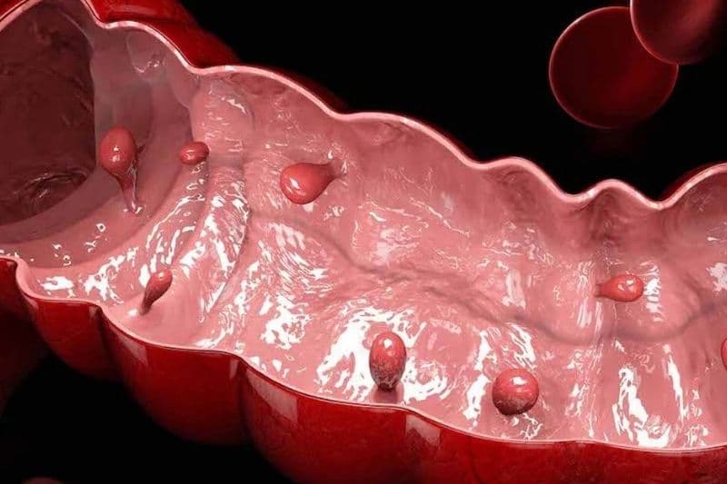 dấu hiệu sớm ung thư đại trực tràng