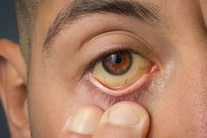 dấu hiệu sớm ung thư tuyến tụy