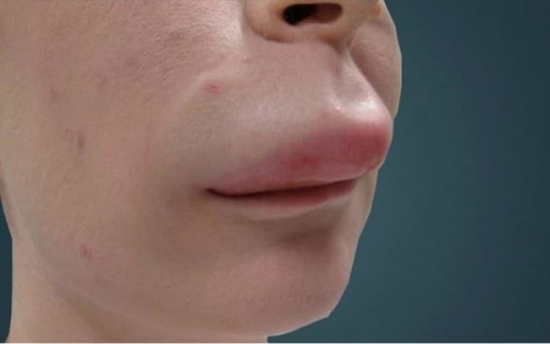 hình ảnh dị ứng thuốc kháng sinh