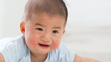 Điều trị lupus ban đỏ ở trẻ em như thế nào?