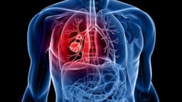 Đột biến gen KRAS trong ung thư phổi