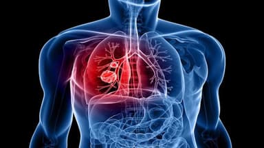 Đột biến PIK3CA trong ung thư phổi không tế bào nhỏ (NSCLC)