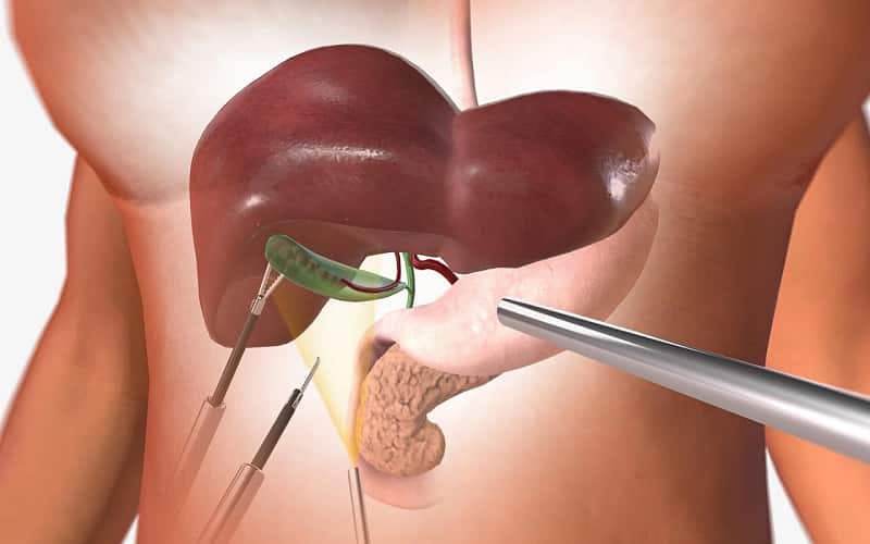 cắt túi mật có ăn hải sản được không