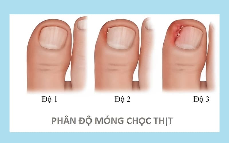 hình ảnh móng chọc thịt