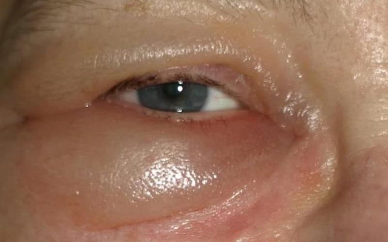 hình ảnh dị ứng thuốc kháng sinh