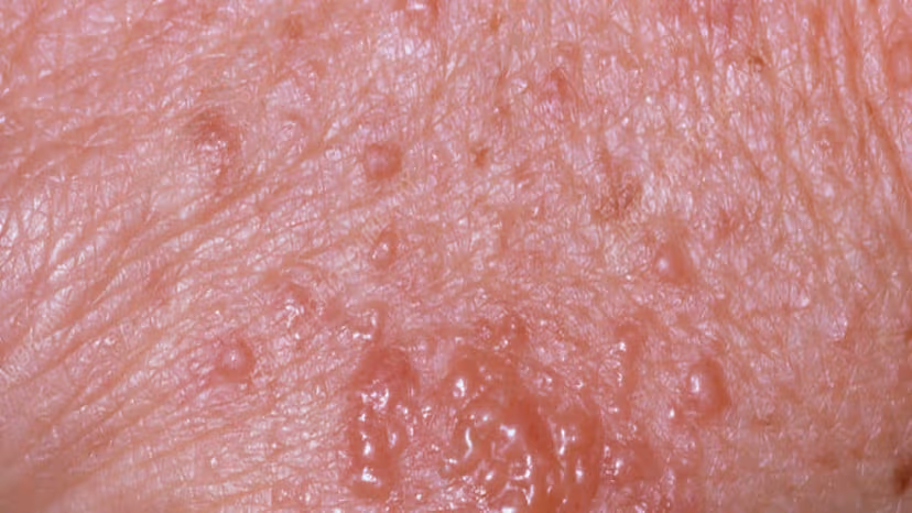 Hình ảnh dị ứng thuốc kháng sinh tại từng bộ phận cơ thể