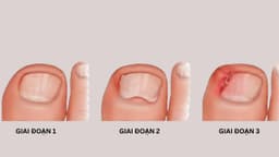 Hình ảnh móng chọc thịt và cách xử lý theo từng cấp độ