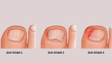 Hình ảnh móng chọc thịt và cách xử lý theo từng cấp độ