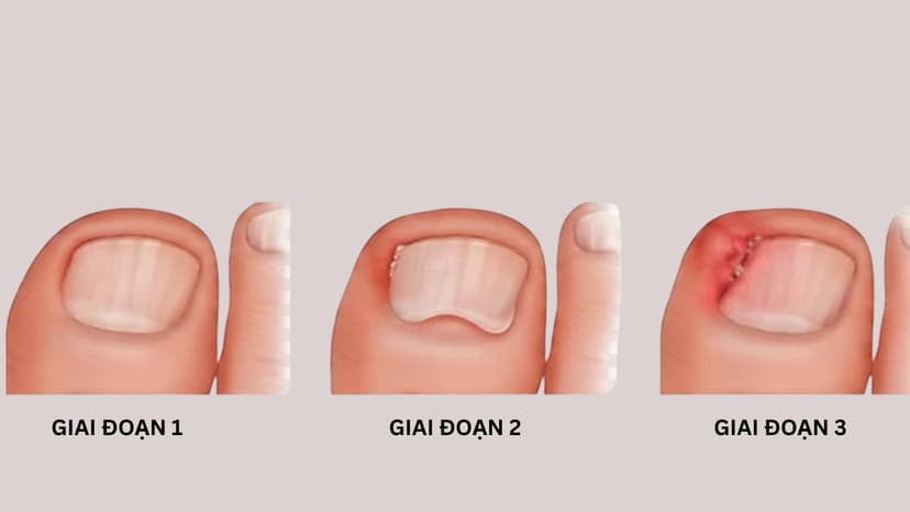 Hình ảnh móng chọc thịt và cách xử lý theo từng cấp độ