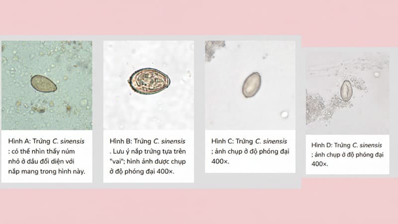 trứng sán lá gan nhỏ dưới kính hiển vi