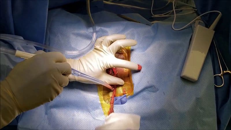 hút dịch áp xe vú