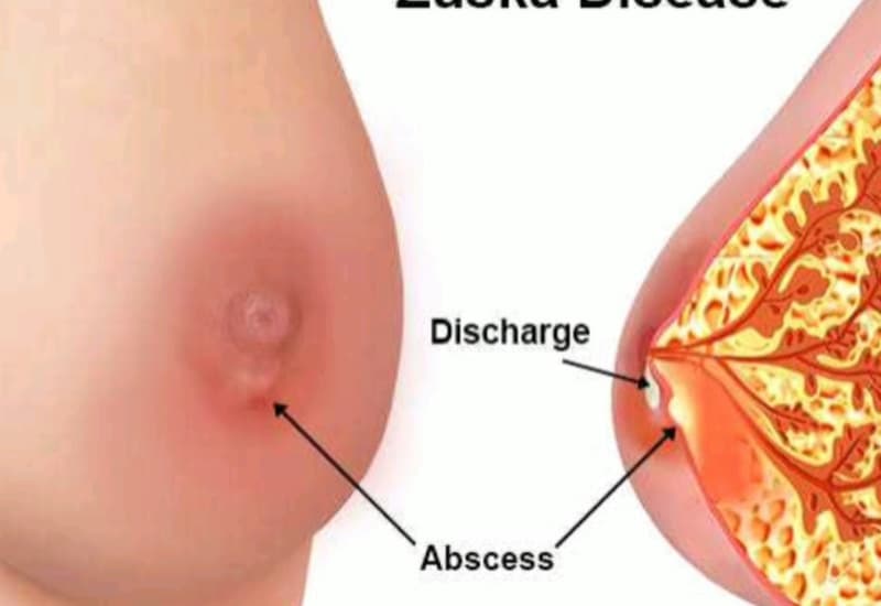 hút dịch áp xe vú
