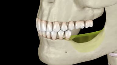 Mất răng bao lâu thì tiêu xương?