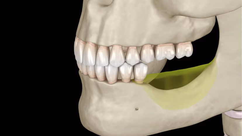Mất răng bao lâu thì tiêu xương?