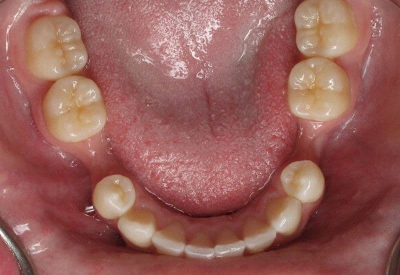 mất răng số 5 có niềng được không