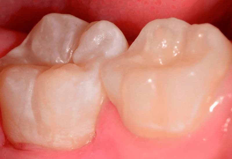 mất răng số 6 và 7 có niềng được không