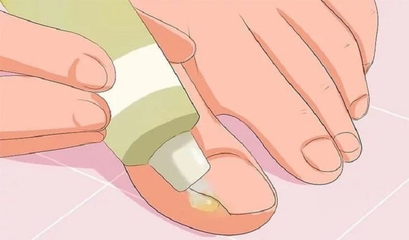 móng chọc thịt có mủ