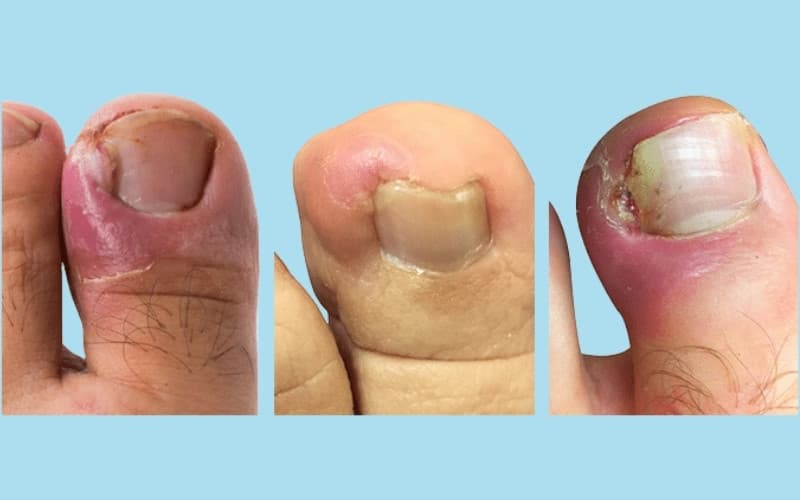 cách xử lý móng chân mọc ngược