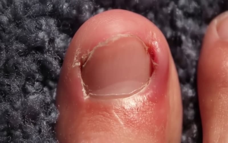 hình ảnh móng chọc thịt