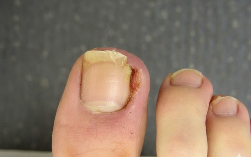 hình ảnh móng chọc thịt