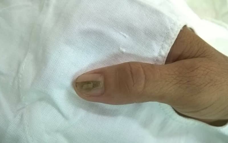 u cuộn mạch dưới móng