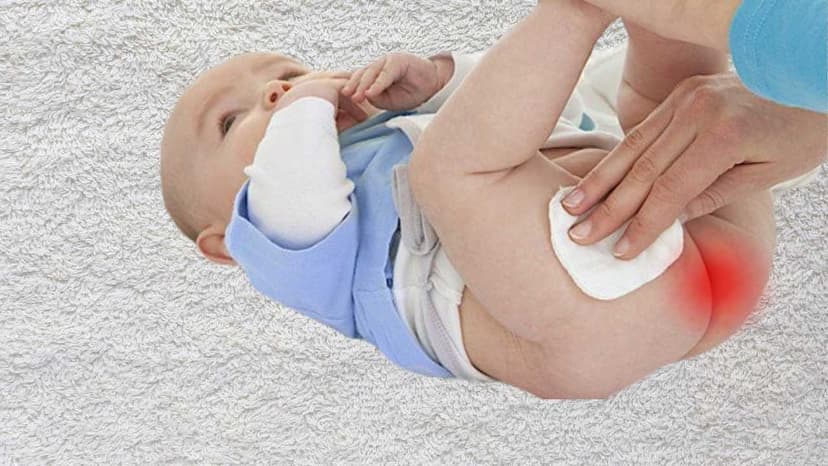 Nếp da thừa hậu môn ở trẻ có bẩm sinh không và khi nào cần can thiệp?