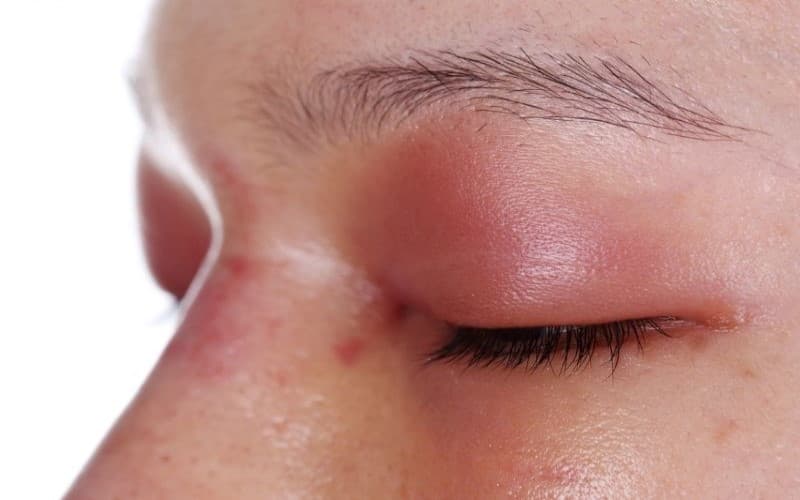 hình ảnh dị ứng thuốc kháng sinh