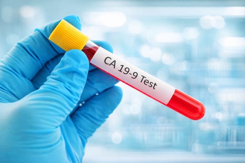 xét nghiệm ung thư tụy