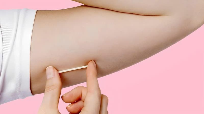 que cấy tránh thai implanon có mấy loại