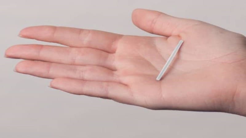 que cấy tránh thai implanon có mấy loại