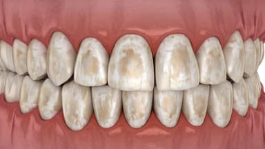 Răng mất khoáng là gì? Tái khoáng men răng thế nào?