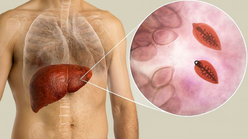 Bị sán lá gan lớn có gây ngứa không?