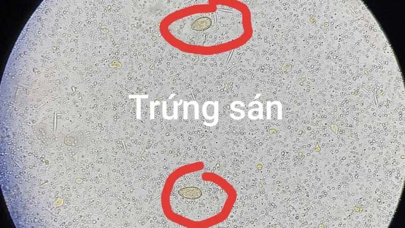 trứng sán lá gan nhỏ dưới kính hiển vi