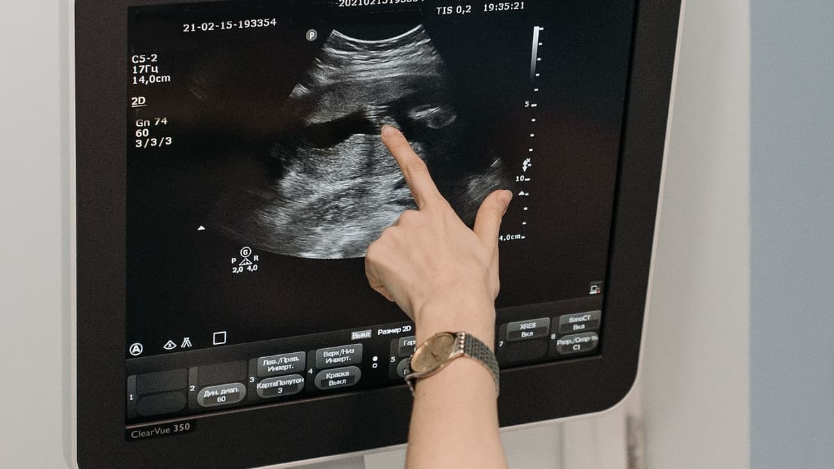 Các chỉ số trong siêu âm doppler tim và cách đọc kết quả