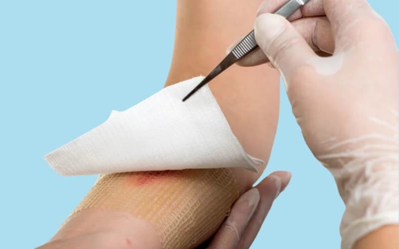 cắt u lành phần mềm đường kính dưới 10cm