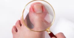 Có cách chữa móng chọc thịt tại nhà không?