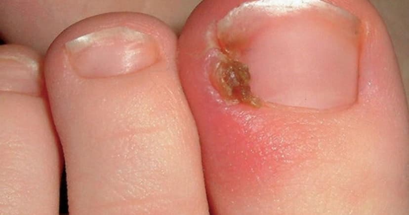 Làm gì khi móng chọc thịt có mủ, tái phát?