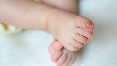 Trẻ sơ sinh bị móng chọc thịt: Nguyên nhân, dấu hiệu và cách xử lý an toàn