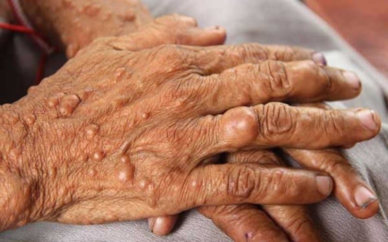 cắt u lành phần mềm đường kính trên 10cm