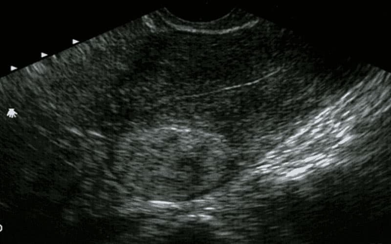 u cơ trơn tử cung có nguy hiểm không