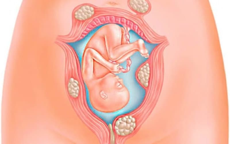 u cơ trơn tử cung có nguy hiểm không