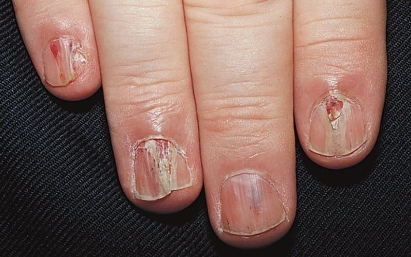 u cuộn mạch dưới móng