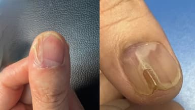 U cuộn mạch dưới móng: Khi nào cần can thiệp y tế?