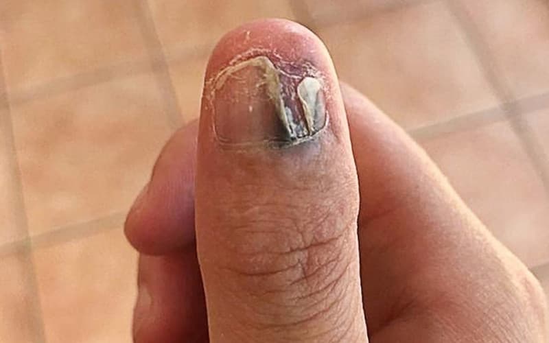 U cuộn mạch dưới móng là một trong các dạng tổn thương hiếm gặp